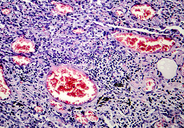 חיידק השחפת, כפי שהוא נראה במיקרוסקופ. מקור: BigStock