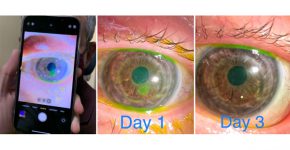 צילום מאקרו ב-iPhone 13 Pro Max של מצב העין במהלך שלושה ימים. צילום: ד"ר טומי קורן, טוויטר