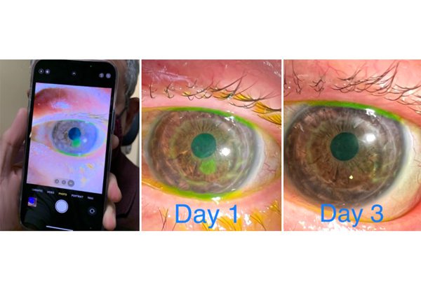 צילום מאקרו ב-iPhone 13 Pro Max של מצב העין במהלך שלושה ימים. צילום: ד"ר טומי קורן, טוויטר