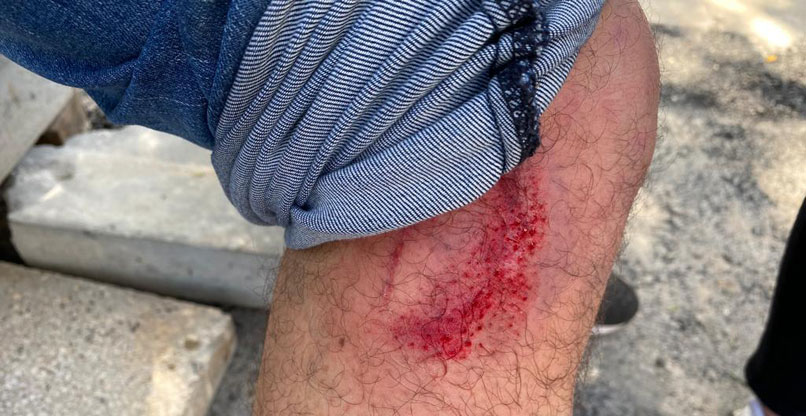 פצוע מירי רימוני ההלם.