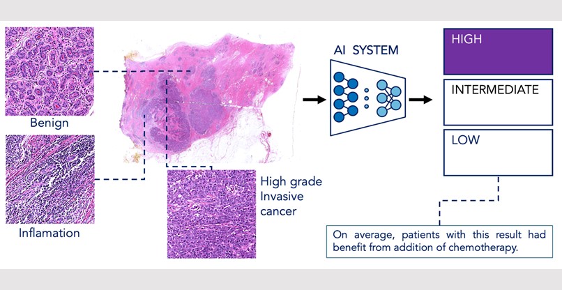 באיור: מערכת ה-AI מפענחת דגימה של רקמת סרטן שד שנסרקה דיגיטלית. המערכת מעריכה את ההסתברות לחזרת המחלה ואת הסבירות לתועלת מטיפול כימותרפי באמצעות ניתוח דפוסים ויזואליים שקשורים להתנהגות הביולוגית של הסרטן, כגון קצב חלוקה של תאים, צורת התאים, מבנה רקמתי המעיד על אגרסיביות וסימנים לתגובה של מערכת החיסון. 